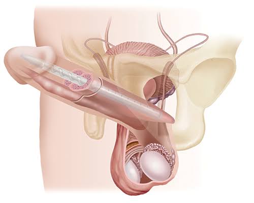 Penile-Implant-RMSH