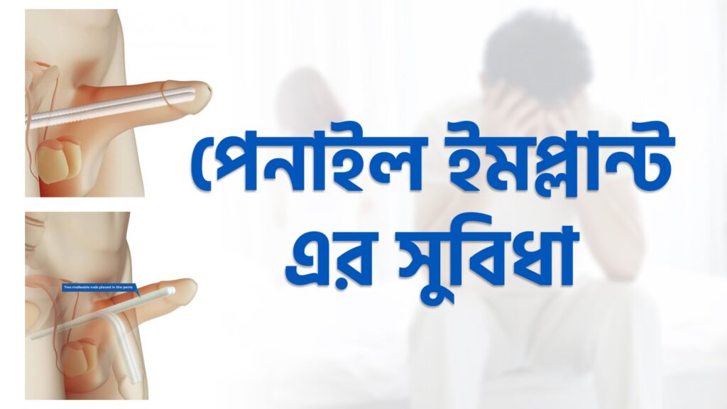 Penile Implant RMSH - Urologist Prof Dr Md Abid Hossain